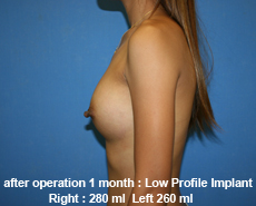 plastic-surgery-breast-augmentation
